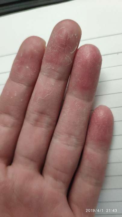 玩游戏手机手指干燥起皮_手指干爆皮_干燥手指脱皮怎么办