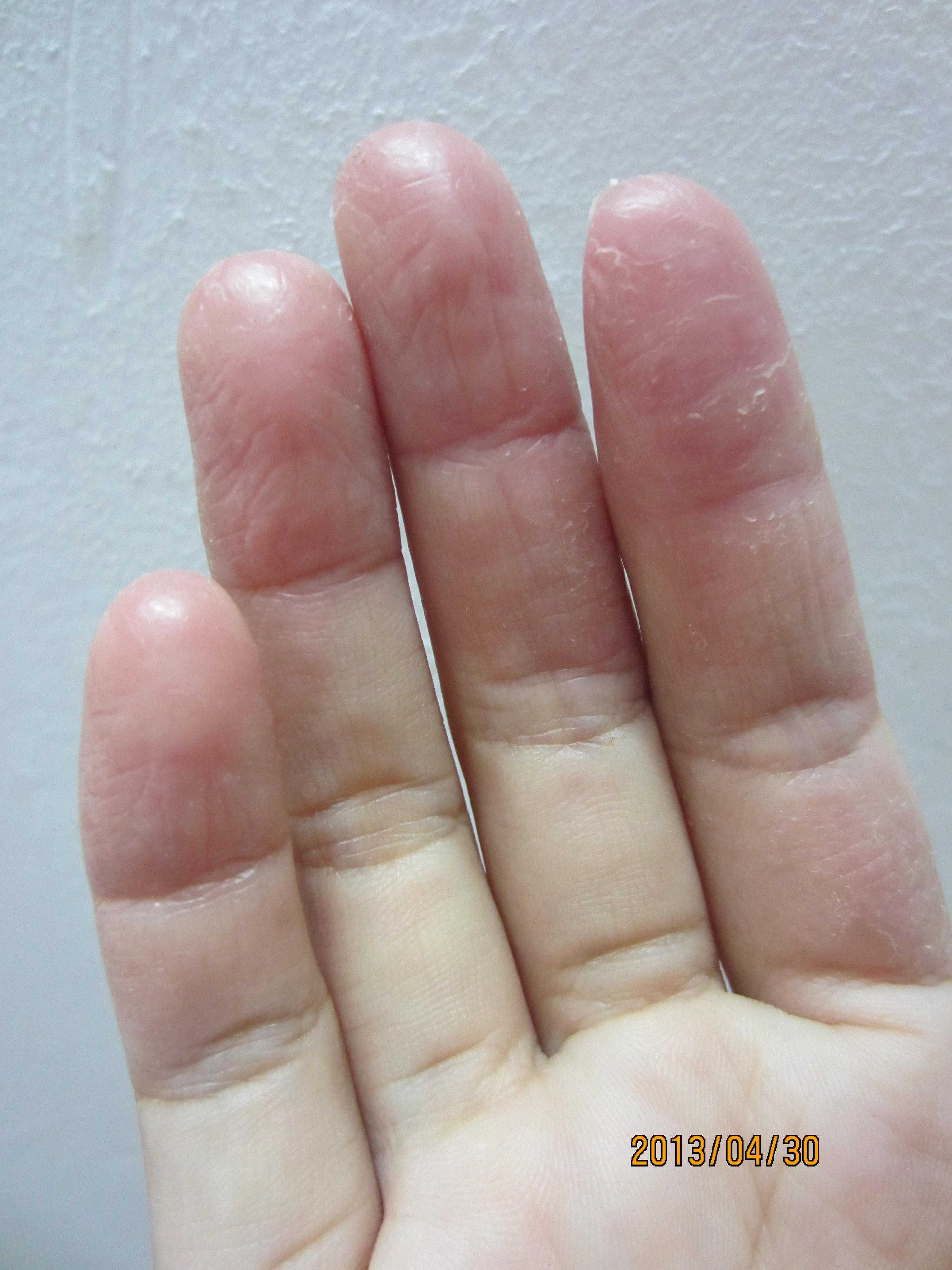 玩游戏手机手指干燥起皮_手指干爆皮_干燥手指脱皮怎么办